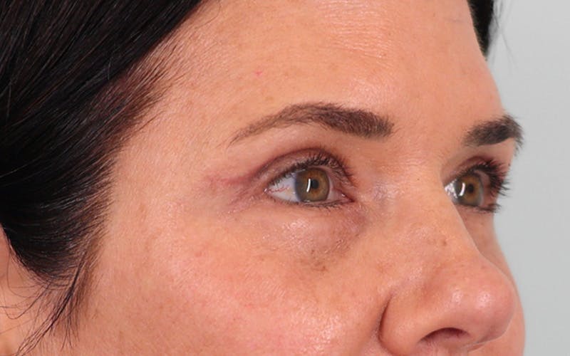 Lower Blepharoplasty Before & After Gallery - Patient 832647 - Image 4