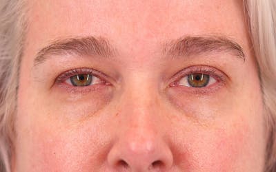 Ptosis Correction Before & After Gallery - Patient 308056 - Image 1