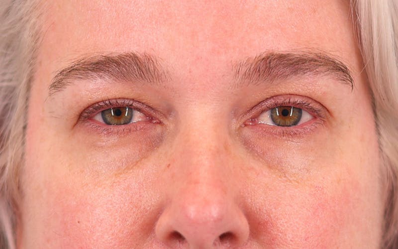 Lower Blepharoplasty Before & After Gallery - Patient 948402 - Image 1