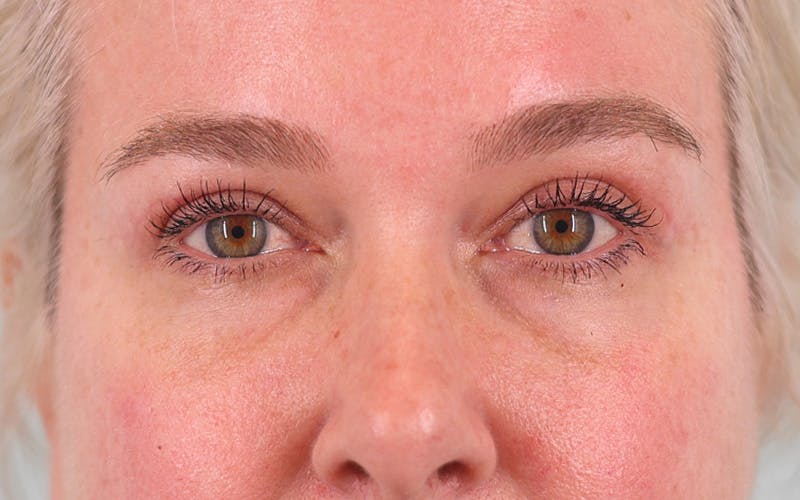 Lower Blepharoplasty Before & After Gallery - Patient 948402 - Image 2