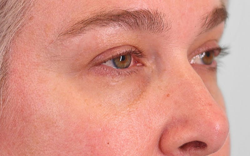 Lower Blepharoplasty Before & After Gallery - Patient 948402 - Image 3