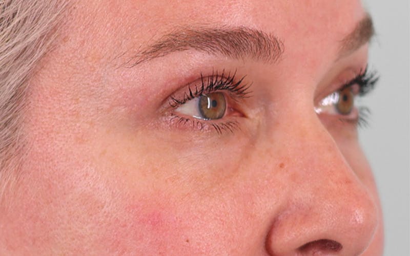 Lower Blepharoplasty Before & After Gallery - Patient 948402 - Image 4