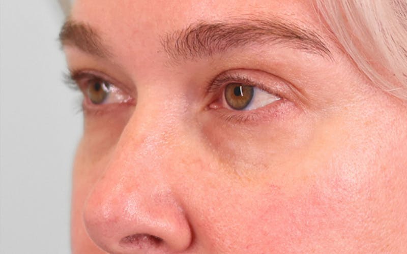 Lower Blepharoplasty Before & After Gallery - Patient 948402 - Image 5