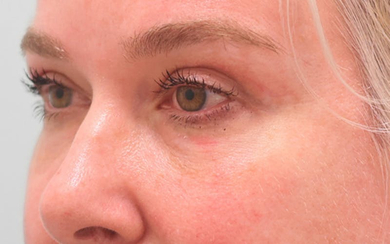 Lower Blepharoplasty Before & After Gallery - Patient 948402 - Image 6
