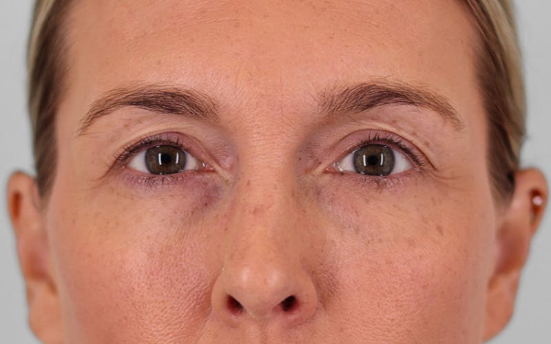 Winged Blepharoplasty Before & After Gallery - Patient 211025 - Image 1