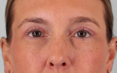 Winged Blepharoplasty Before & After Gallery - Patient 211025 - Image 2