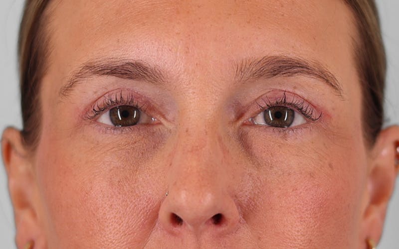 Winged Blepharoplasty Before & After Gallery - Patient 211025 - Image 2