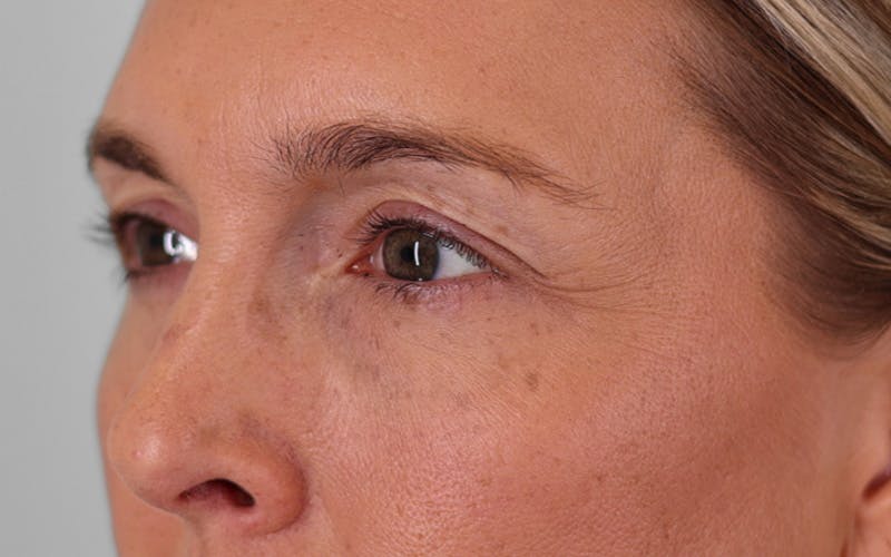 Winged Blepharoplasty Before & After Gallery - Patient 211025 - Image 5