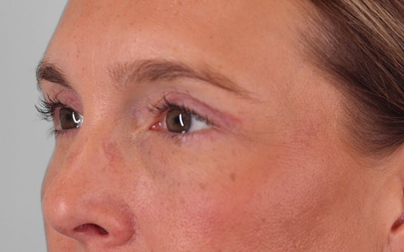 Winged Blepharoplasty Before & After Gallery - Patient 211025 - Image 6