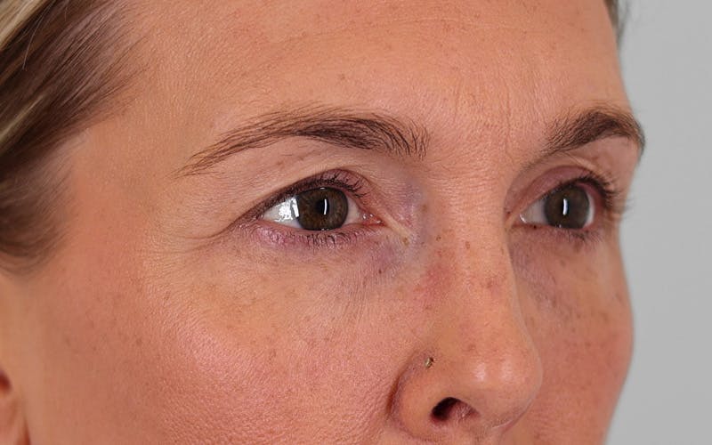 Winged Blepharoplasty Before & After Gallery - Patient 211025 - Image 3