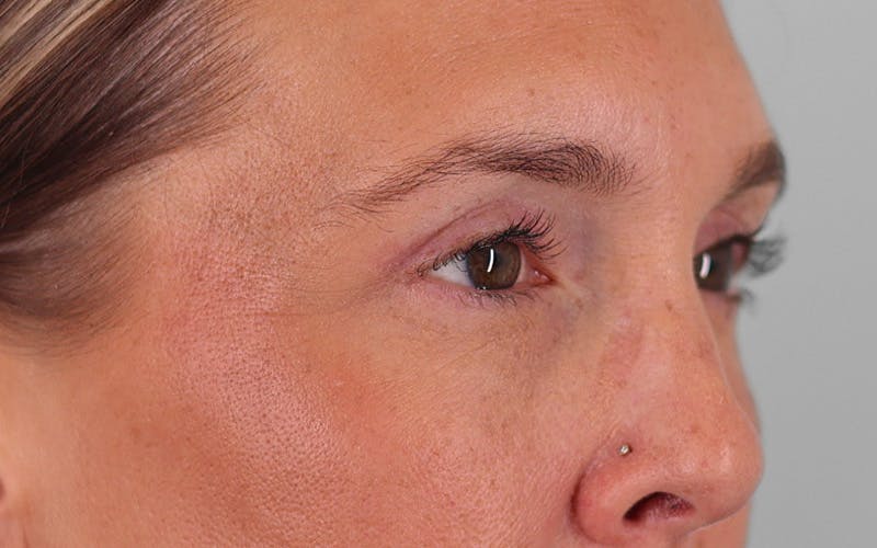 Winged Blepharoplasty Before & After Gallery - Patient 211025 - Image 4