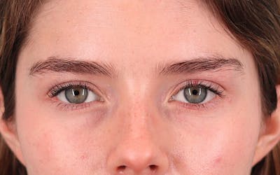 Canthopexy Before & After Gallery - Patient 714833 - Image 1