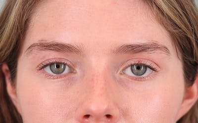 Canthopexy Before & After Gallery - Patient 714833 - Image 2