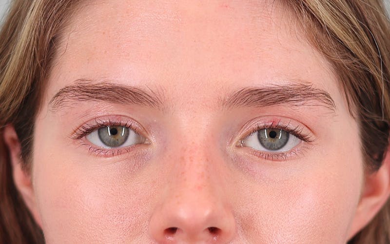 Canthopexy Before & After Gallery - Patient 714833 - Image 2