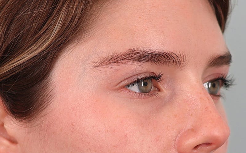 Canthopexy Before & After Gallery - Patient 714833 - Image 3