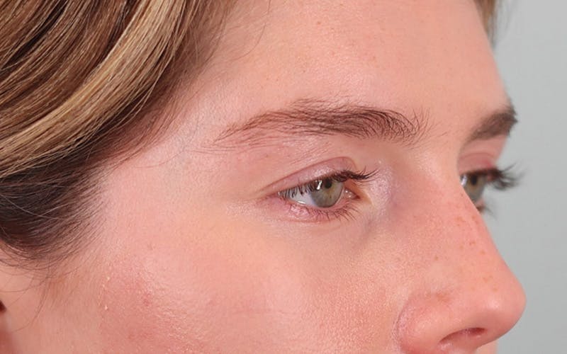 Canthopexy Before & After Gallery - Patient 714833 - Image 4