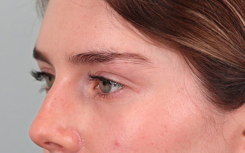 Canthopexy Before & After Gallery - Patient 714833 - Image 5