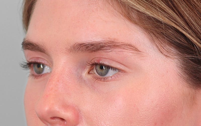 Canthopexy Before & After Gallery - Patient 714833 - Image 6