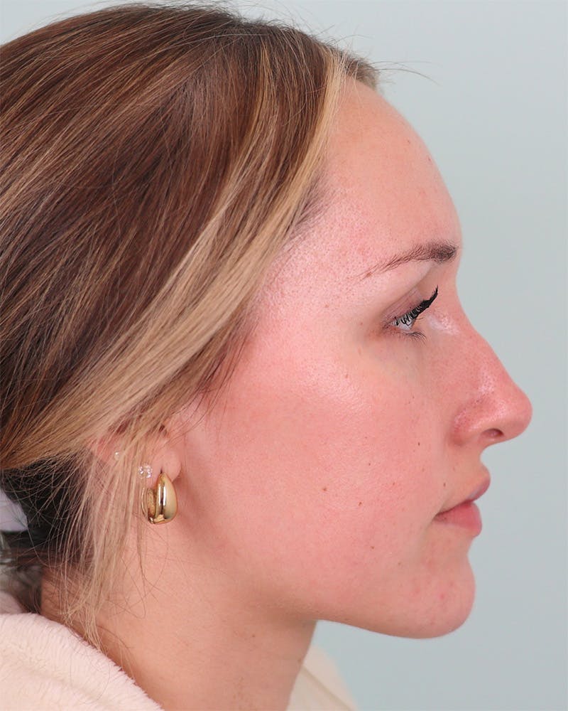 Rhinoplasty Before & After Gallery - Patient 134625 - Image 1