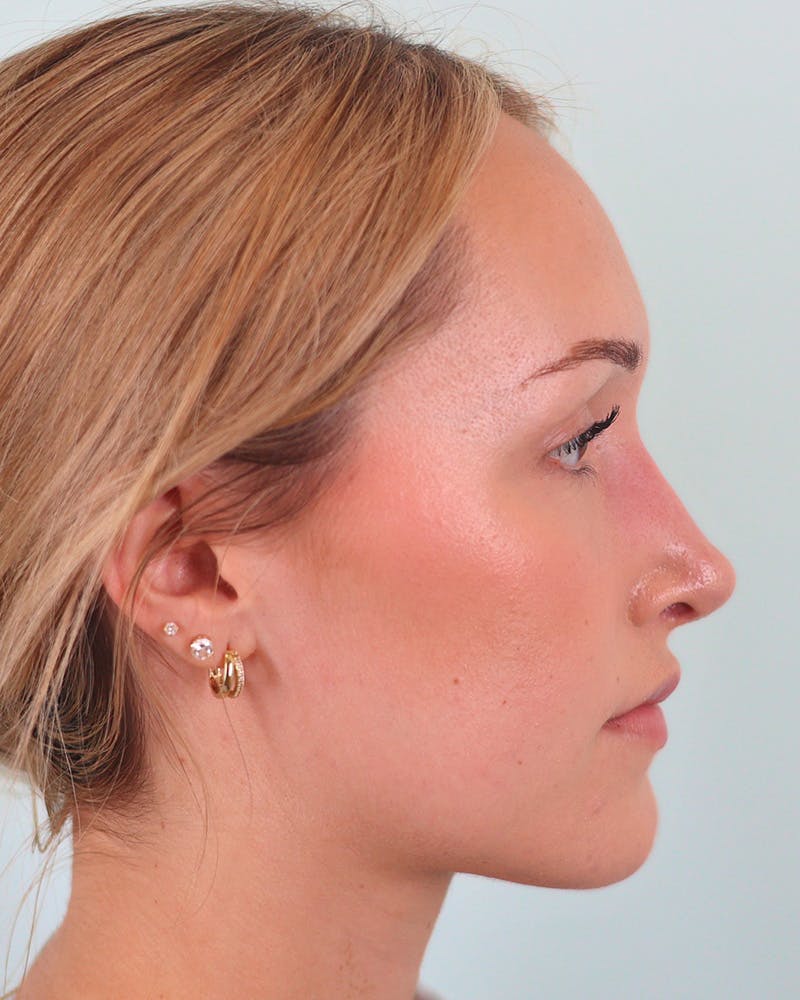 Rhinoplasty Before & After Gallery - Patient 134625 - Image 2