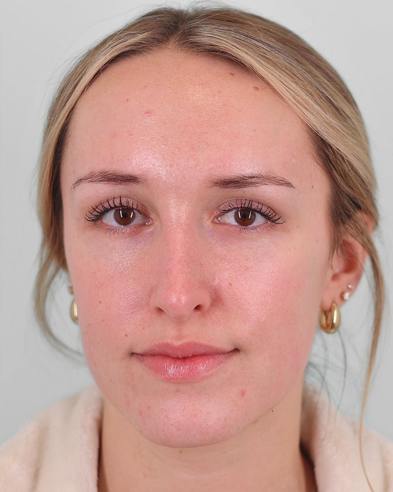 Rhinoplasty Before & After Gallery - Patient 134625 - Image 5