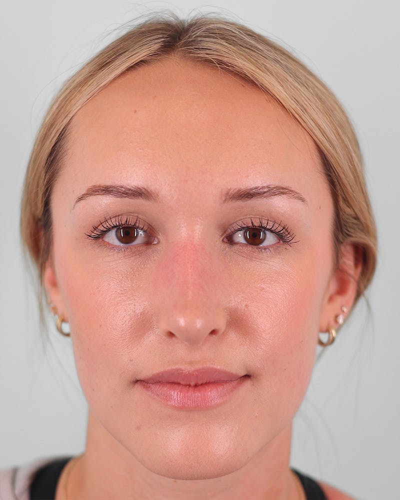 Rhinoplasty Before & After Gallery - Patient 134625 - Image 6