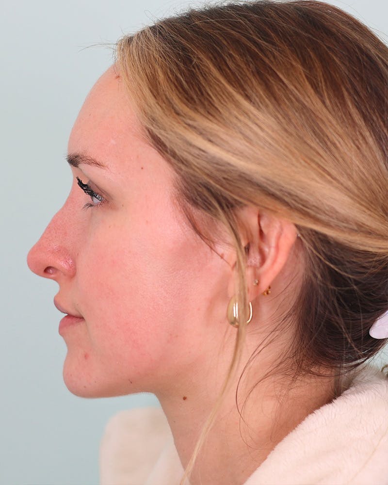 Rhinoplasty Before & After Gallery - Patient 134625 - Image 3