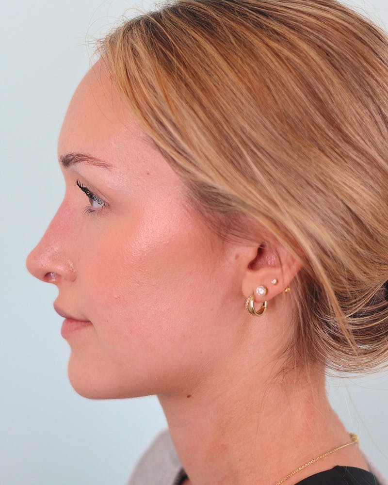Rhinoplasty Before & After Gallery - Patient 134625 - Image 4