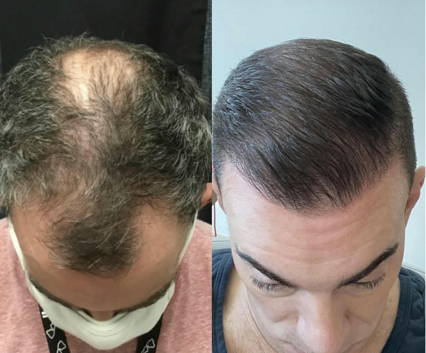 before and after Bio Restorative Hair Grafting
