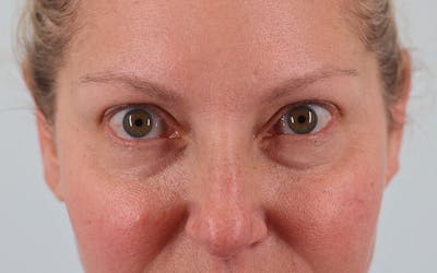 Lower Blepharoplasty Before & After Gallery - Patient 471166 - Image 1