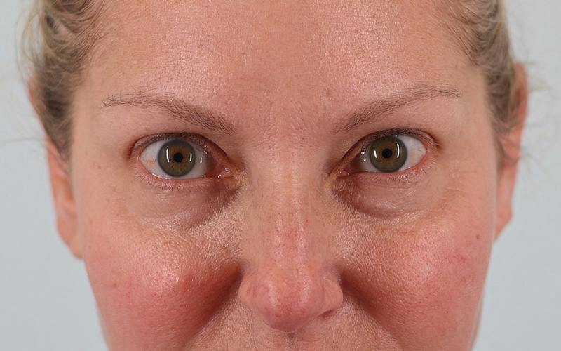 Winged Blepharoplasty Before & After Gallery - Patient 533679 - Image 1
