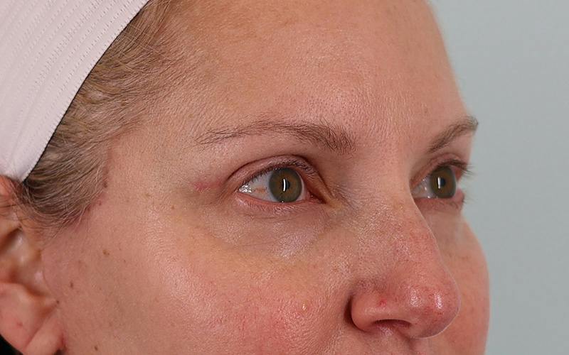 Winged Blepharoplasty Before & After Gallery - Patient 533679 - Image 4