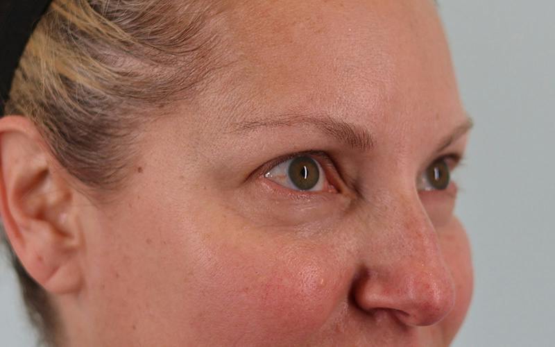 Winged Blepharoplasty Before & After Gallery - Patient 533679 - Image 3