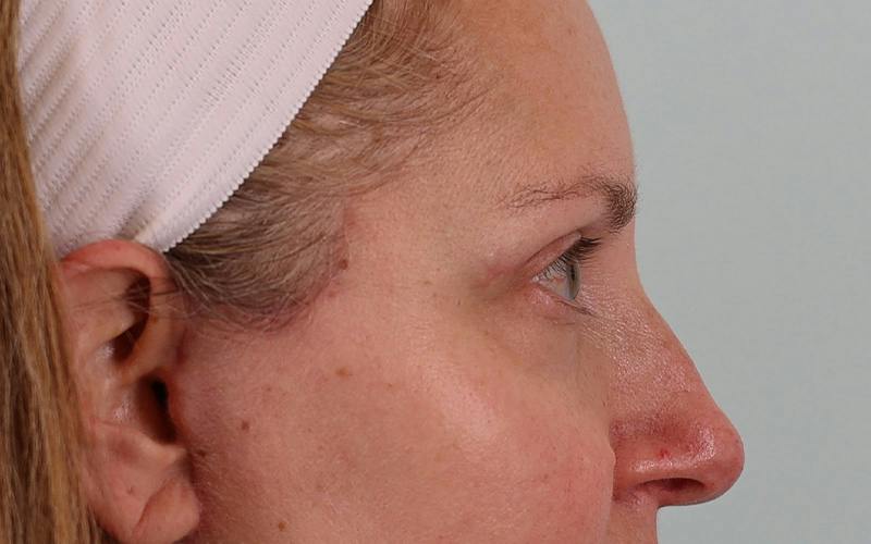 Winged Blepharoplasty Before & After Gallery - Patient 533679 - Image 6