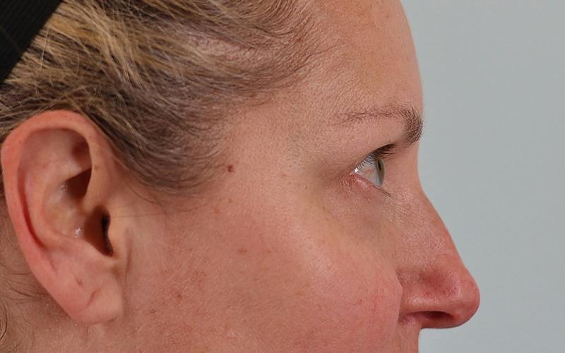 Winged Blepharoplasty Before & After Gallery - Patient 533679 - Image 5