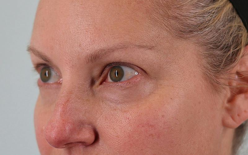 Winged Blepharoplasty Before & After Gallery - Patient 533679 - Image 7