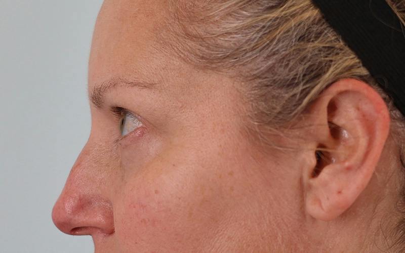 Winged Blepharoplasty Before & After Gallery - Patient 533679 - Image 9