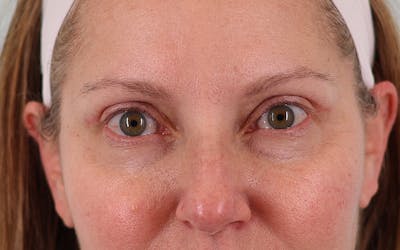 Lower Blepharoplasty Before & After Gallery - Patient 471166 - Image 2