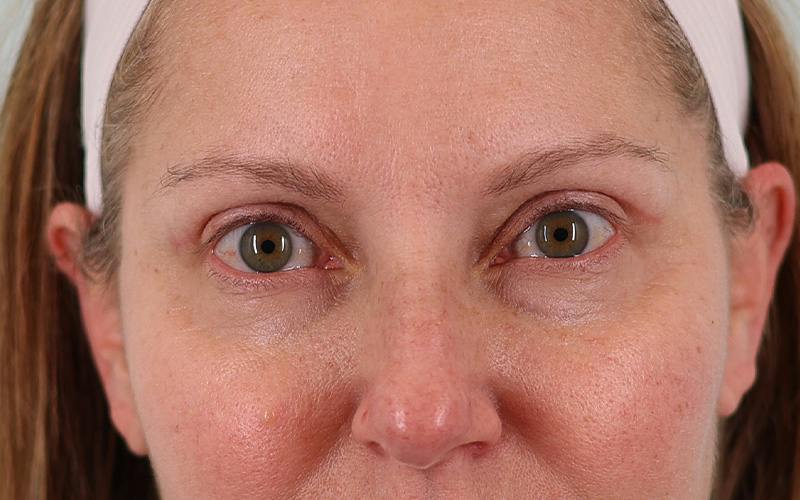 Winged Blepharoplasty Before & After Gallery - Patient 533679 - Image 2