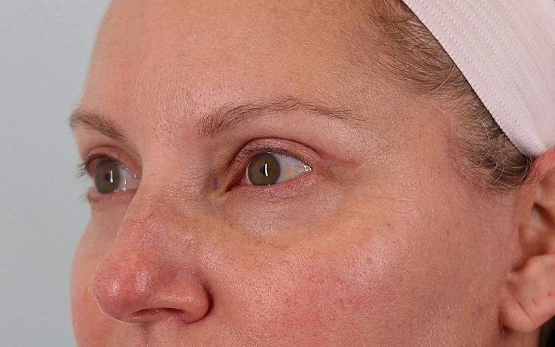 Winged Blepharoplasty Before & After Gallery - Patient 533679 - Image 8