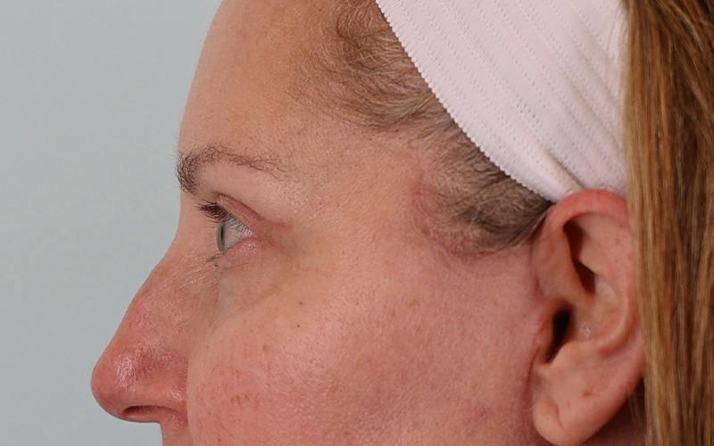 Winged Blepharoplasty Before & After Gallery - Patient 533679 - Image 10