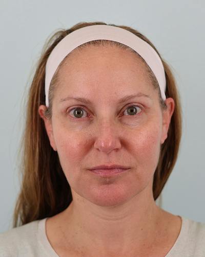 Facelift Before & After Gallery - Patient 302433 - Image 2
