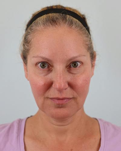 Facelift Before & After Gallery - Patient 302433 - Image 1