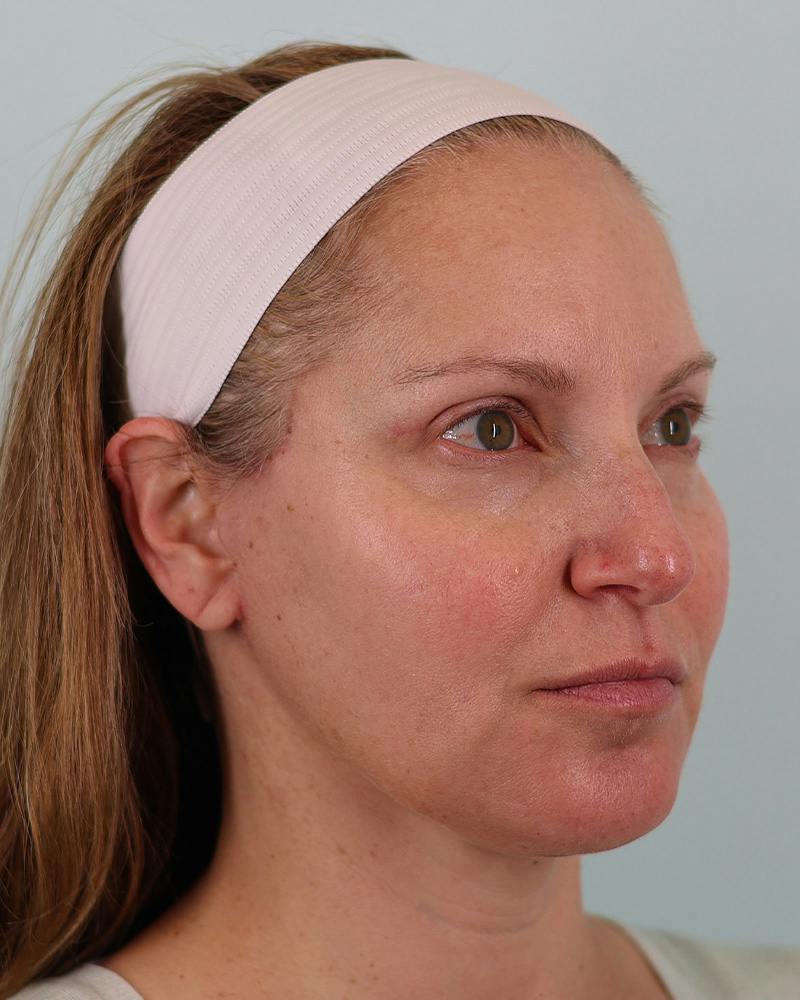 Facial Fat Transfer Before & After Gallery - Patient 103564 - Image 4