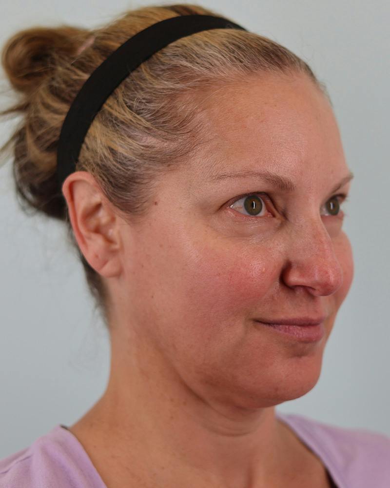Facial Fat Transfer Before & After Gallery - Patient 103564 - Image 3