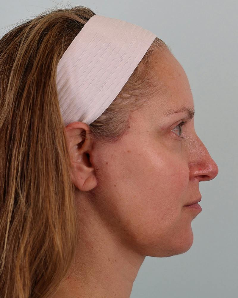 Facial Fat Transfer Before & After Gallery - Patient 103564 - Image 6
