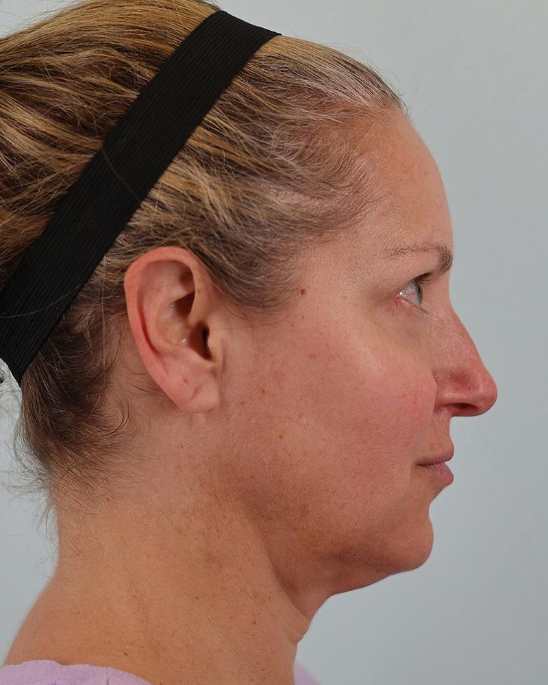 Facial Fat Transfer Before & After Gallery - Patient 103564 - Image 5