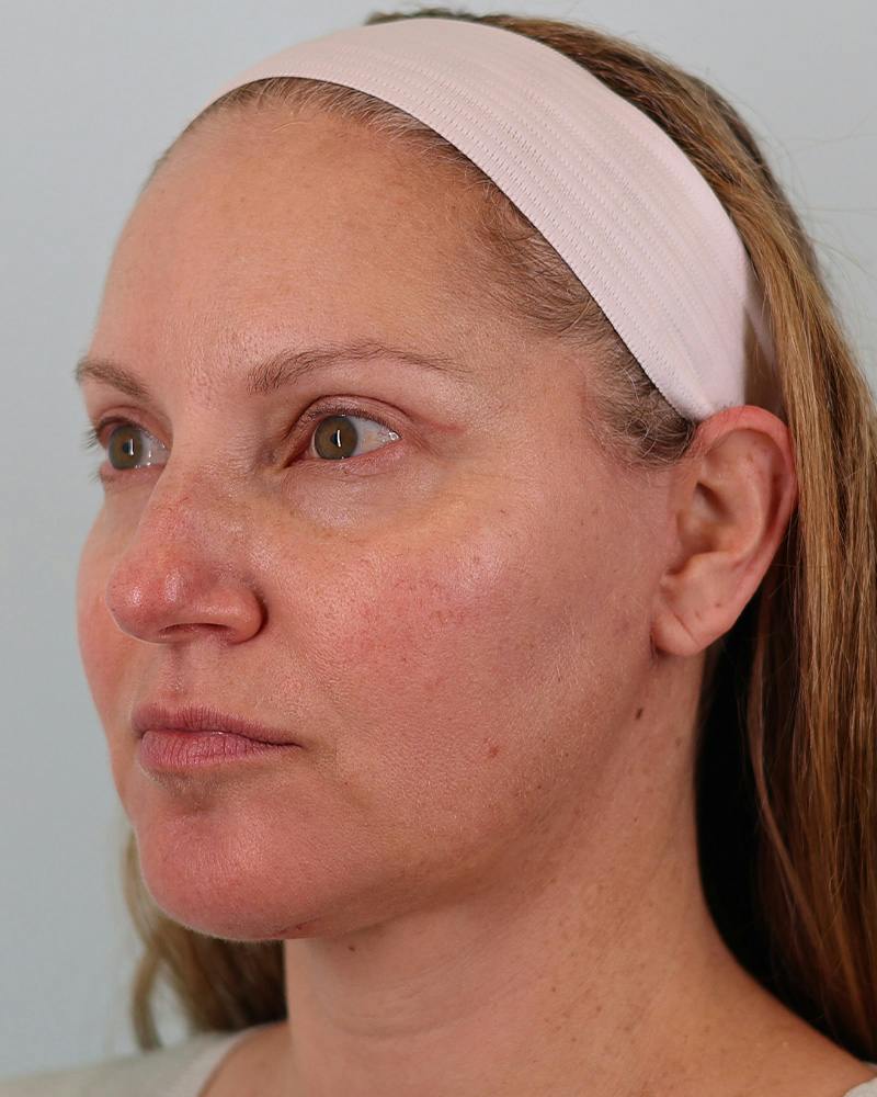 Facial Fat Transfer Before & After Gallery - Patient 103564 - Image 10