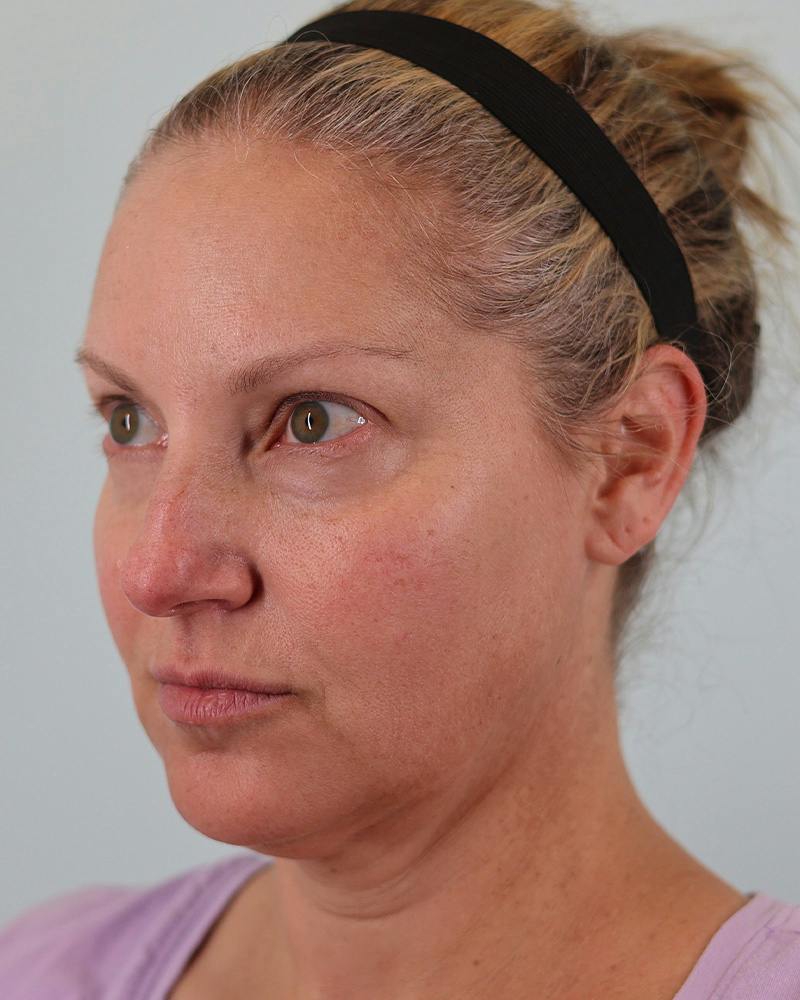 Facial Fat Transfer Before & After Gallery - Patient 103564 - Image 9