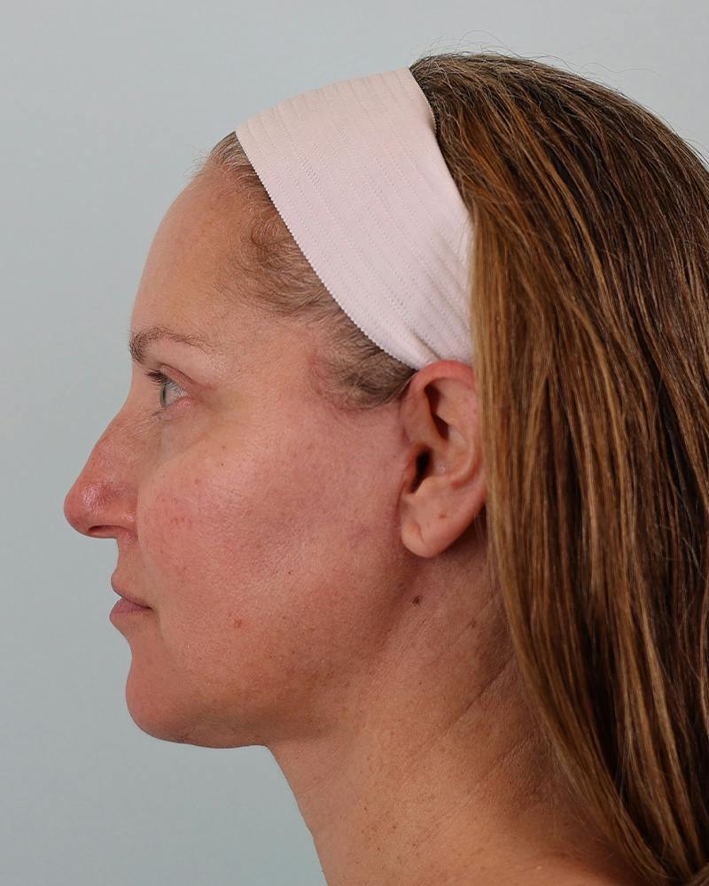 Facial Fat Transfer Before & After Gallery - Patient 103564 - Image 12